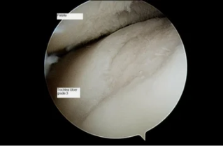 type of astroscope in the knee with osteoarthritis) 3rd grade