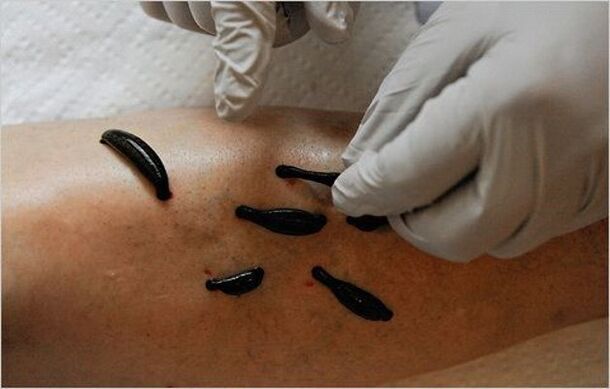 treatment of knee osteoarthritis with leeches