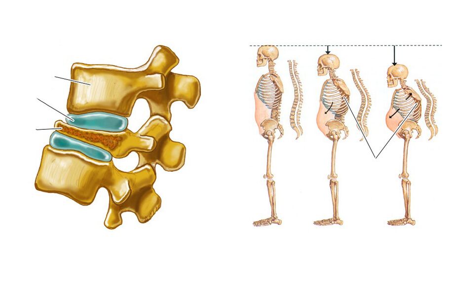 a flabby spine causes back pain