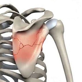 Fracture of the scapula is one of the causes of severe pain