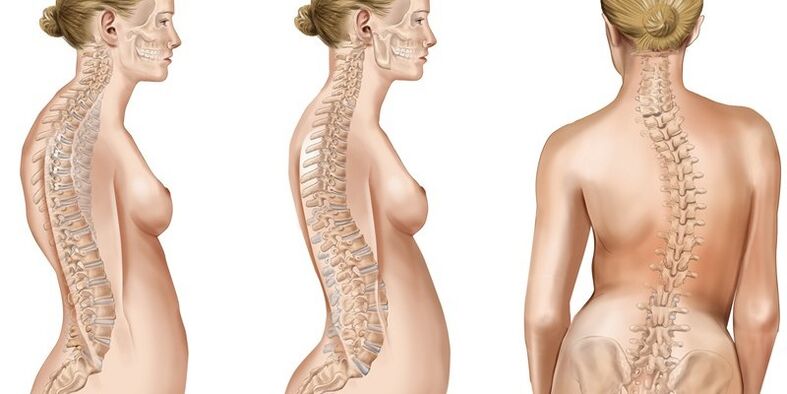 Scoliosis of the thoracic spine causes the appearance of pain in the shoulder blades. 