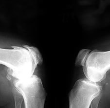 Osteoarthritis in ray