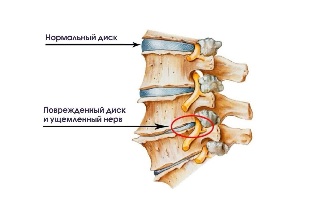 The symptoms of degenerative disc disease cervical