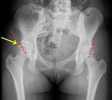 methods of treating osteoarthritis of the hip joint