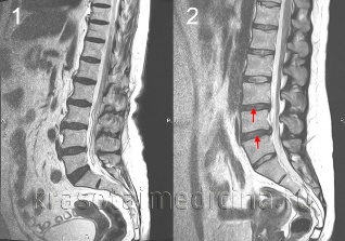 the osteochondrosis of the spine