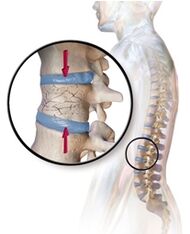 Osteoporosis causes back pain in the lower back. 