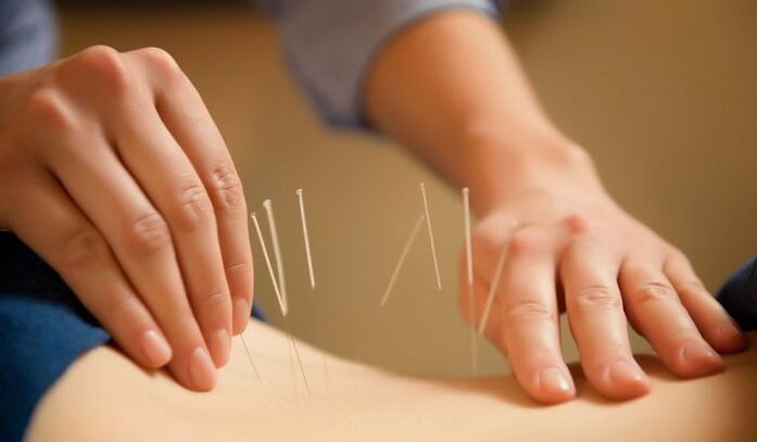 acupuncture to treat low back pain