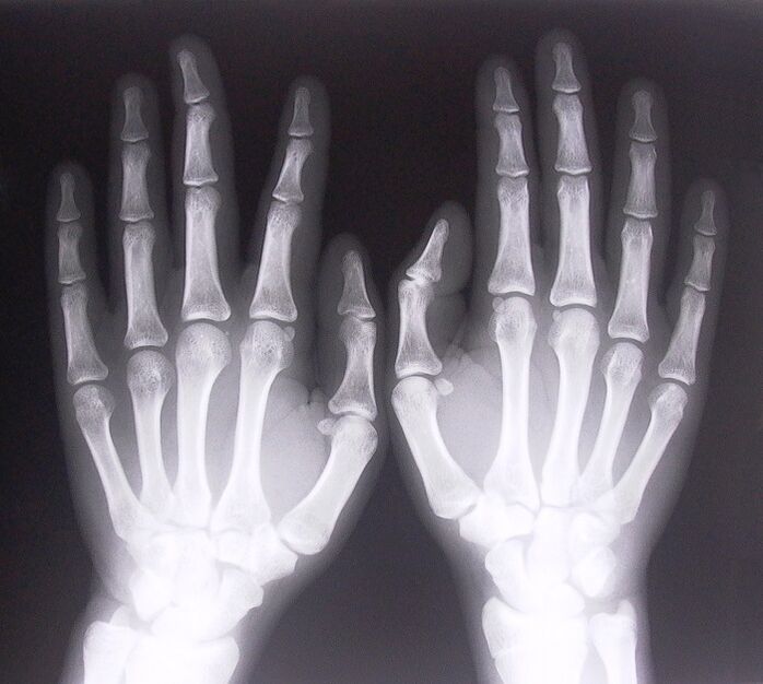 X-ray as a way to diagnose pain in the finger joints. 