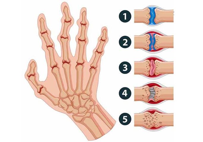 stages of development of arthritis of the finger joints. 